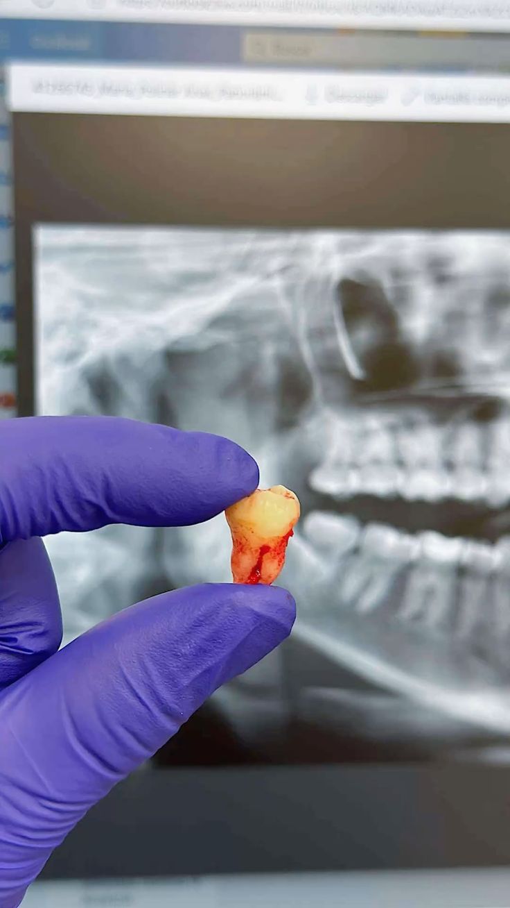 Extracted tooth held in front of a dental X-ray