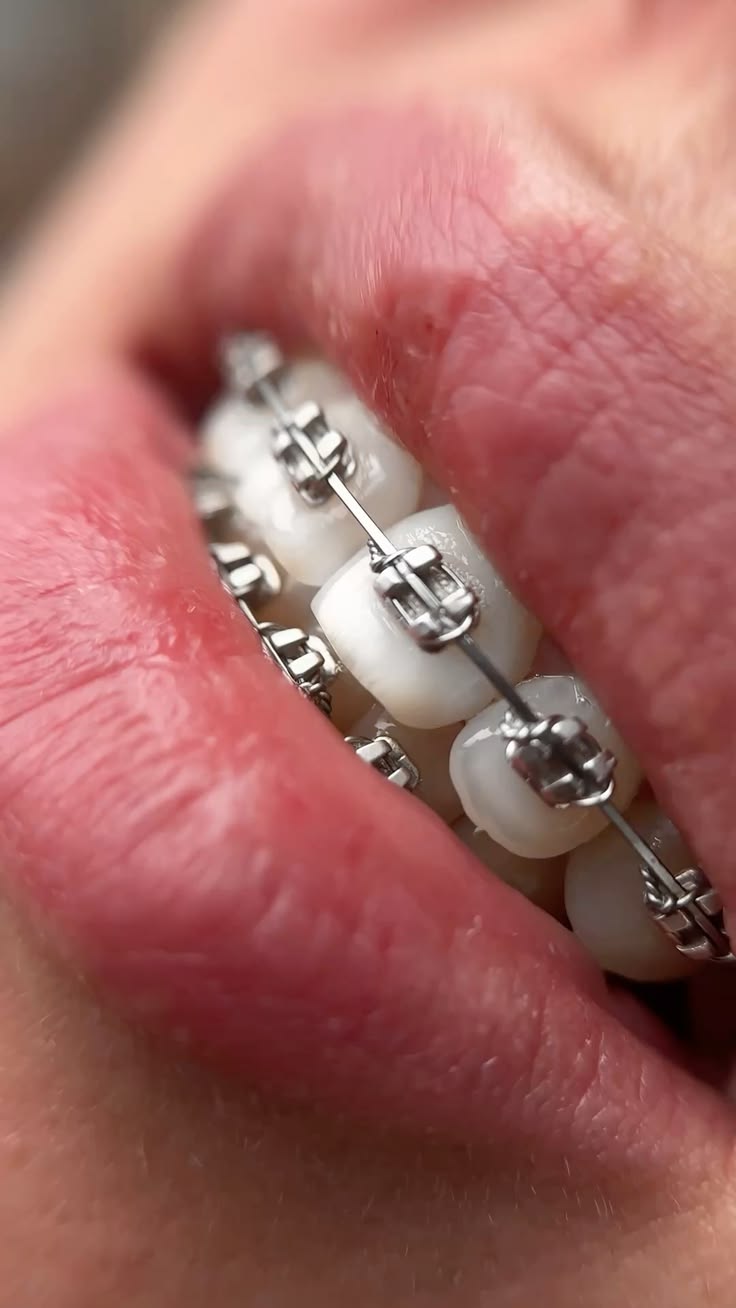 Close-up view of orthodontic braces