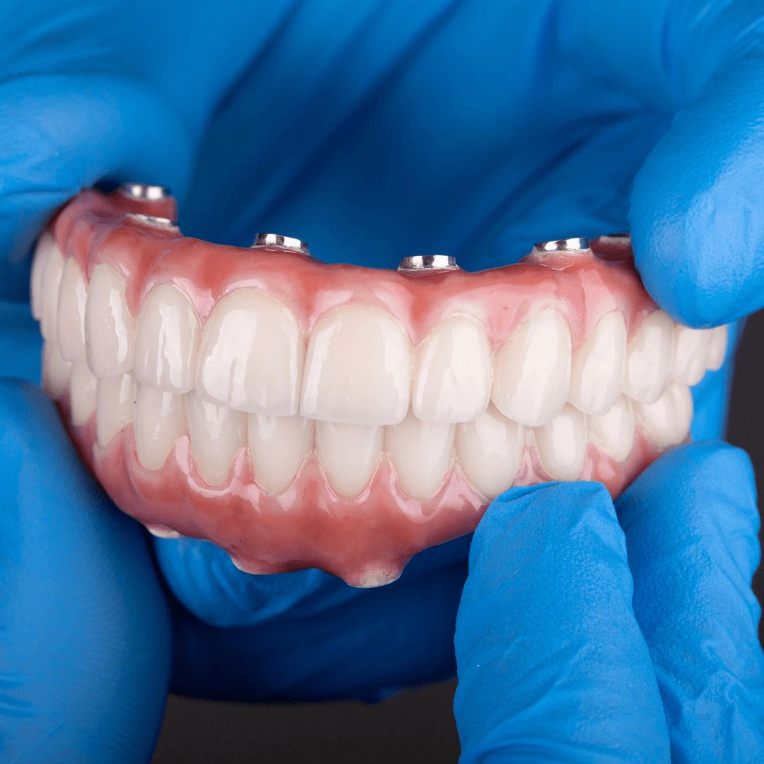 Implant-supported dental prosthesis held by gloved hands