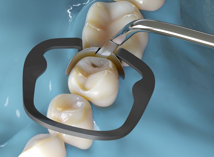 Dental restoration being placed on a prepared tooth