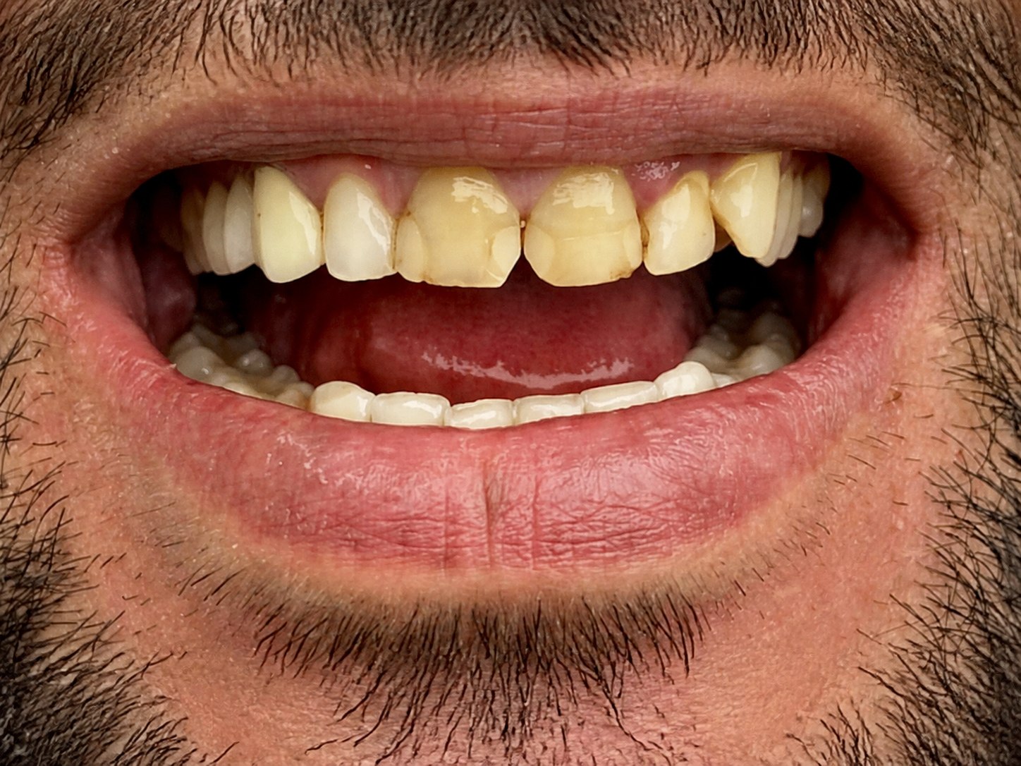 Patient's smile before treatment in Smile Story 01